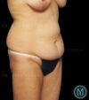 Tummy Tuck case #13580