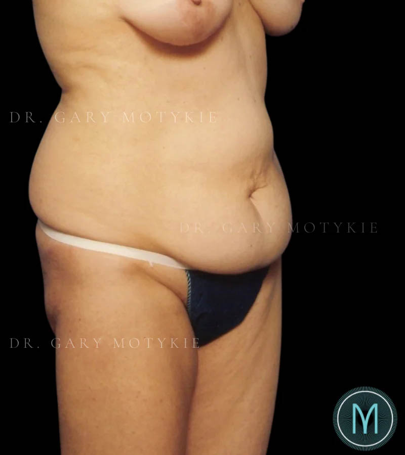Tummy Tuck case #13580