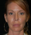 Revision Rhinoplasty case #13461