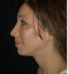 Rhinoplasty case #12822