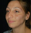 Rhinoplasty case #12822