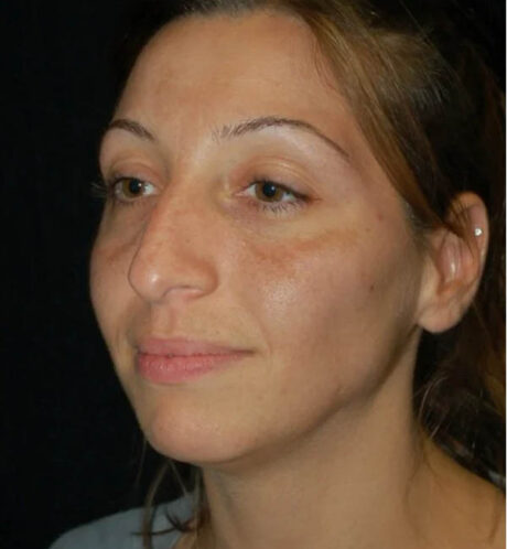 Rhinoplasty case #12822