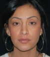 Revision Rhinoplasty case #13468