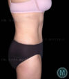 Tummy Tuck case #13580