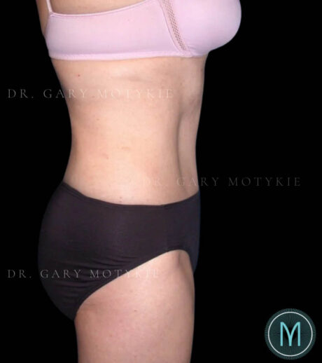 Tummy Tuck case #13580