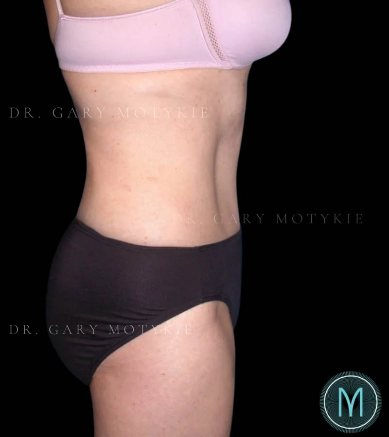 Tummy Tuck case #13580