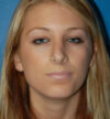 Rhinoplasty case #12829