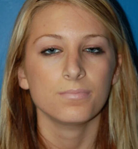 Rhinoplasty case #12829