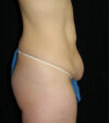 Tummy Tuck case #13585