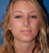 Rhinoplasty case #12829