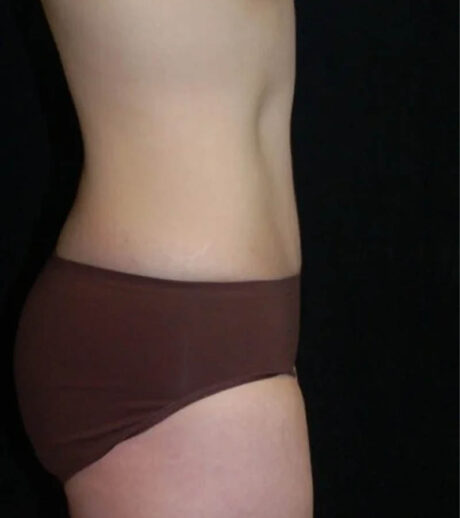 Tummy Tuck case #13585