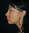 Revision Rhinoplasty case #13468