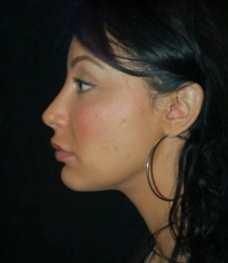 Revision Rhinoplasty case #13468