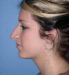 Rhinoplasty case #12829