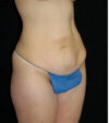 Tummy Tuck case #13585