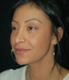 Revision Rhinoplasty case #13468