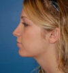 Rhinoplasty case #12829