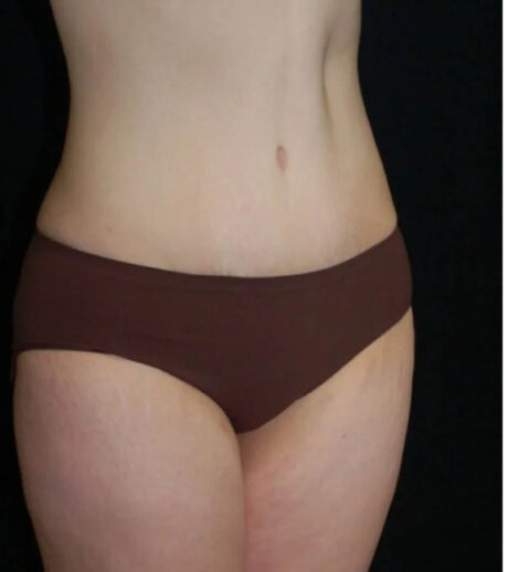 Tummy Tuck case #13585