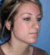 Rhinoplasty case #12829