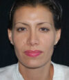 Revision Rhinoplasty case #13475