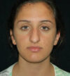 Rhinoplasty case #12840