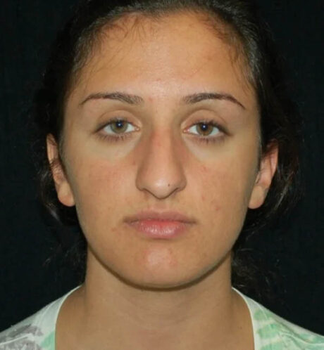 Rhinoplasty case #12840