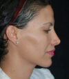 Revision Rhinoplasty case #13475