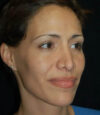 Revision Rhinoplasty case #13475