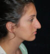 Rhinoplasty case #12840