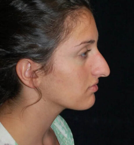 Rhinoplasty case #12840