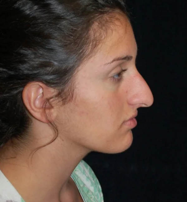 Rhinoplasty case #12840
