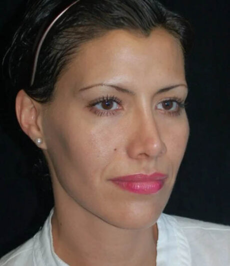 Revision Rhinoplasty case #13475