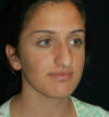 Rhinoplasty case #12840