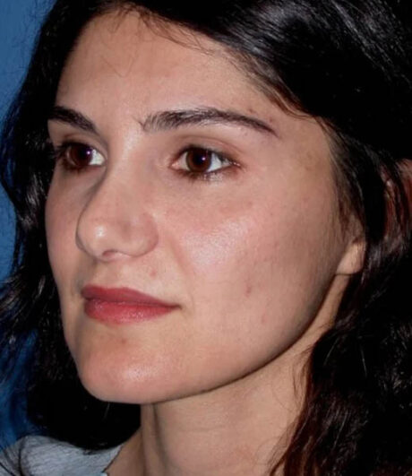 Revision Rhinoplasty case #13485
