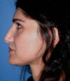 Revision Rhinoplasty case #13485