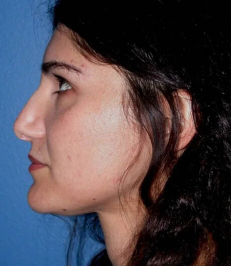 Revision Rhinoplasty case #13485