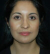 Rhinoplasty case #12847