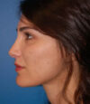 Revision Rhinoplasty case #13485