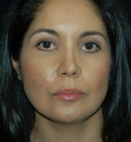Rhinoplasty case #12847