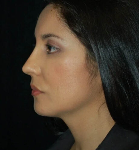 Rhinoplasty case #12847