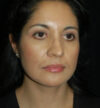 Rhinoplasty case #12847