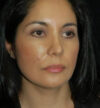 Rhinoplasty case #12847