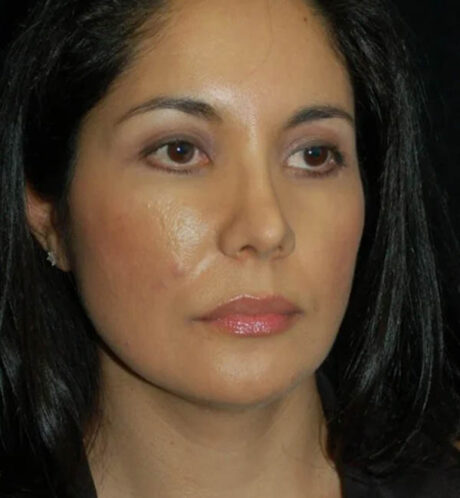 Rhinoplasty case #12847