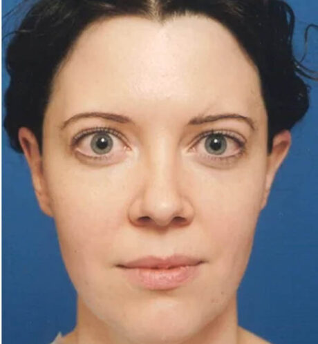 Rhinoplasty case #12856