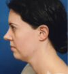 Rhinoplasty case #12856