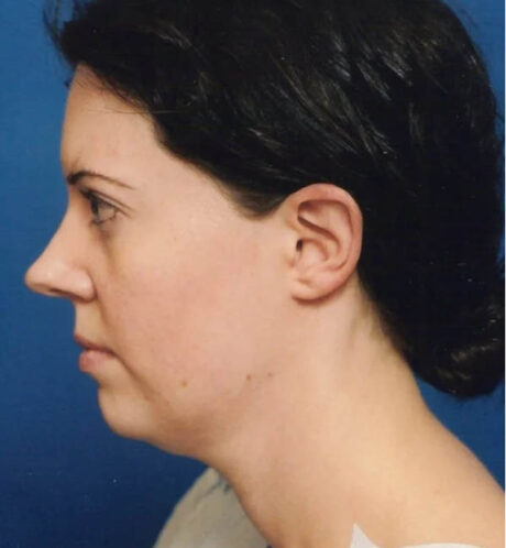 Rhinoplasty case #12856