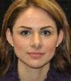 Revision Rhinoplasty case #13493