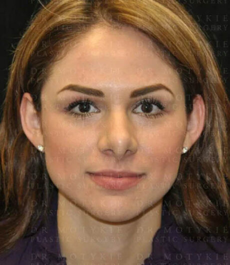 Revision Rhinoplasty case #13493