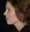 Rhinoplasty case #12856