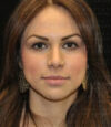 Revision Rhinoplasty case #13493